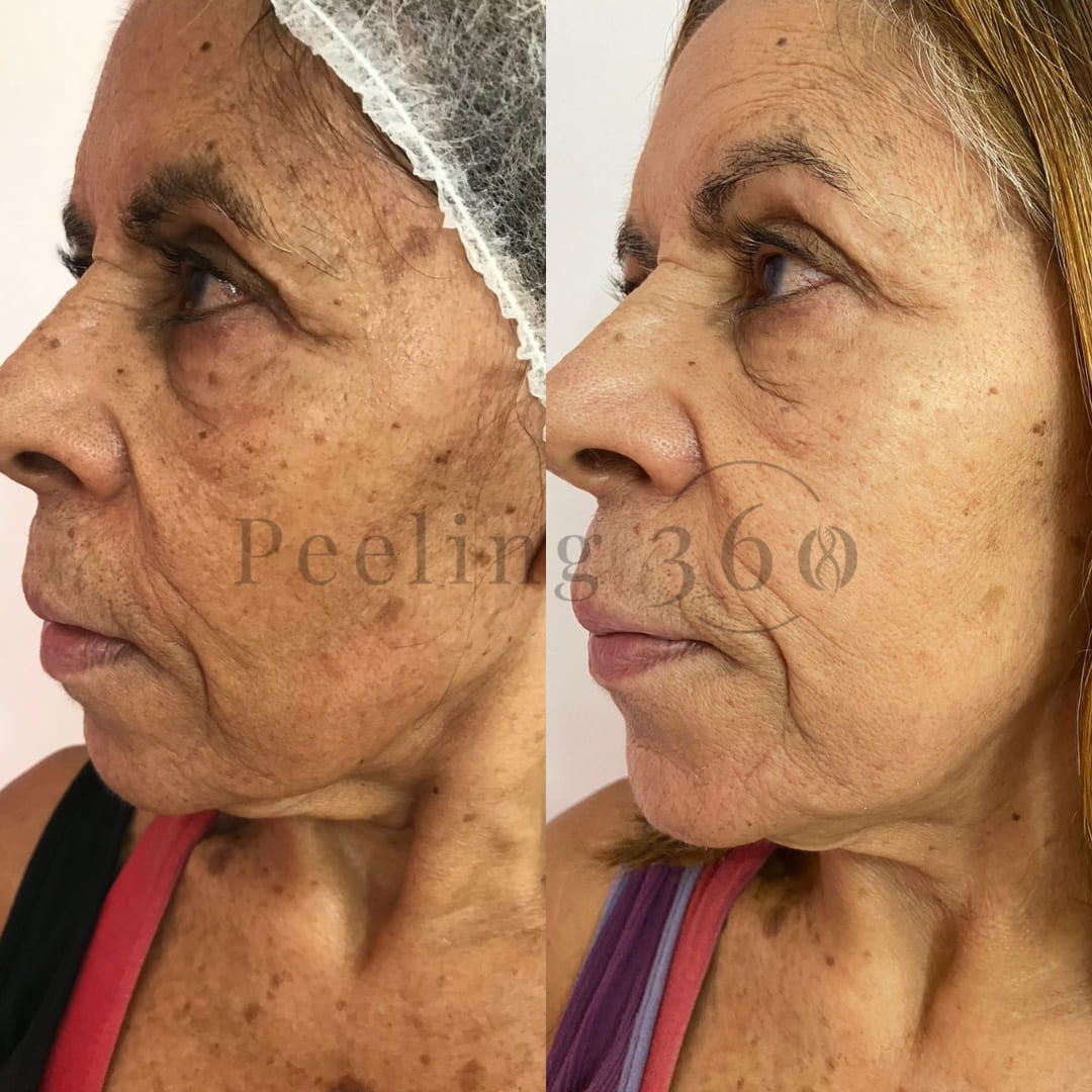 Algae Peeling Basic Kit | Complete Procedure