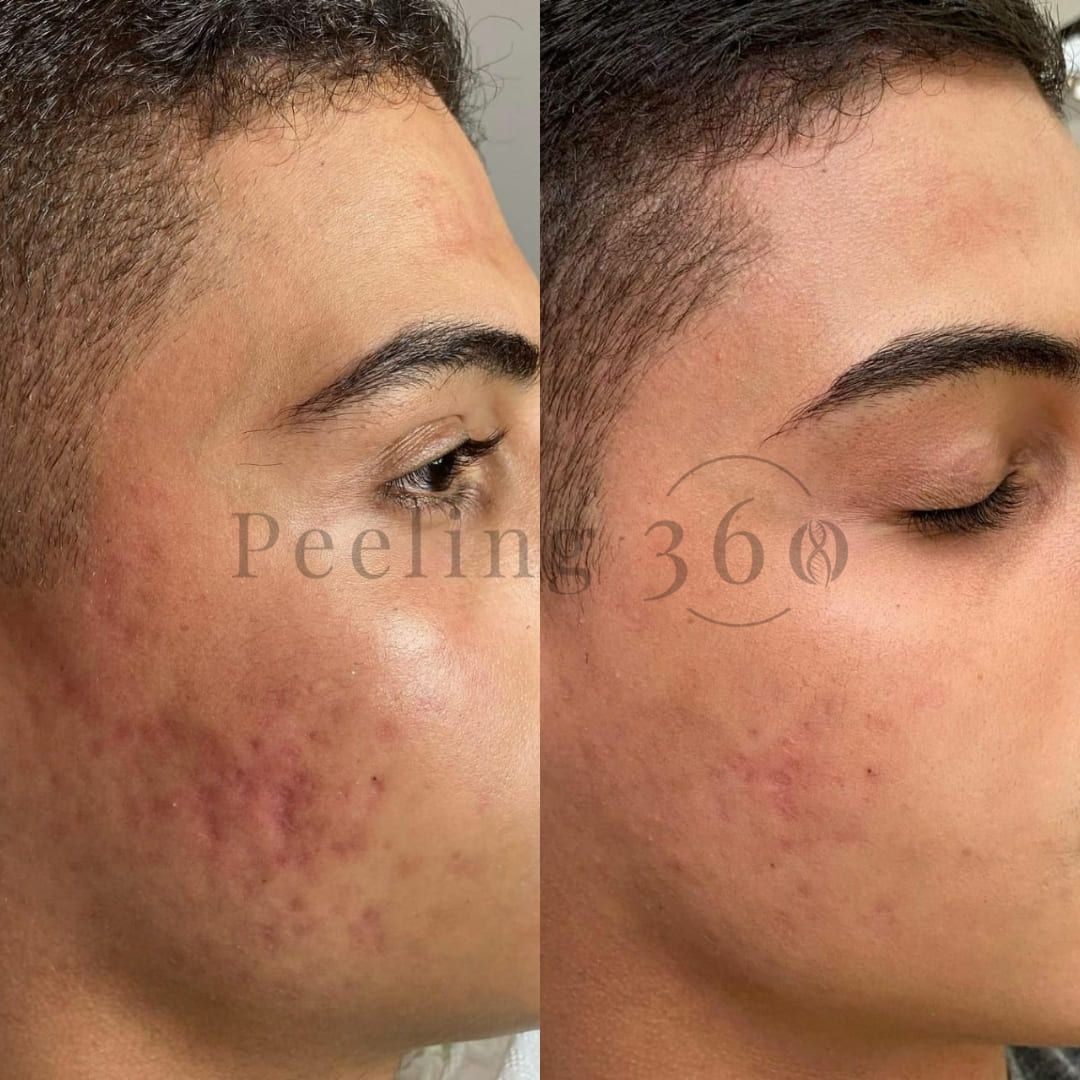 Algae Peeling Basic Kit | Complete Procedure