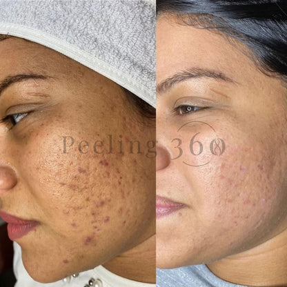 Algae Peeling | Organic