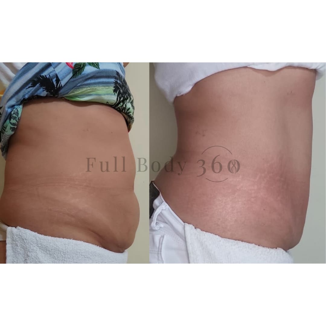 PPC Miracle Cream | Mesolipotherapy