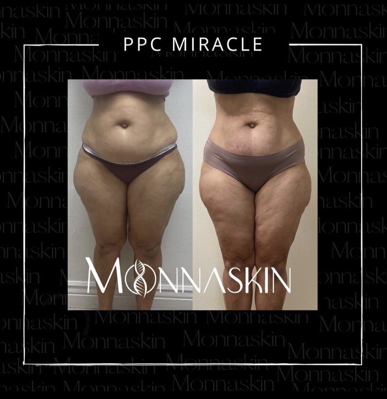 PPC Miracle Cream | Mesolipotherapy