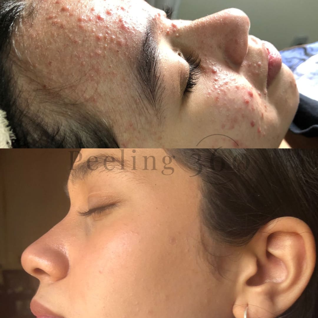 Algae Peeling | Organic